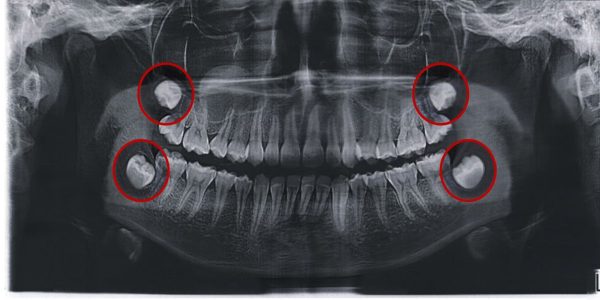 متخصص-جراح-دندان-عقل-600x300